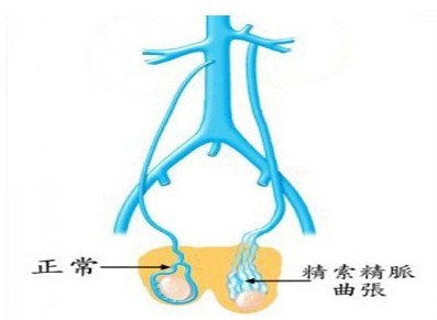 广州40岁三代试管婴儿包成功
：广州生殖健康医院如何治疗精索静脉曲张不孕不育。